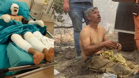 "Yanıyorum" feryadıyla akıllara kazınmıştı! Orman yangınında ağır yaralanan işçinin son hali ortaya çıktı