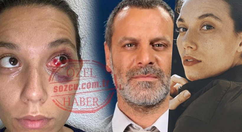Ozan Güven’den şiddet gördüğünü iddia eden Deniz Bulutsuz’un adli tıp raporu ortaya çıktı!